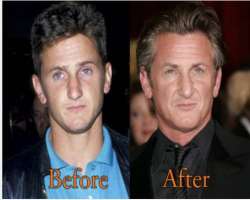 Sean Penn before surgery